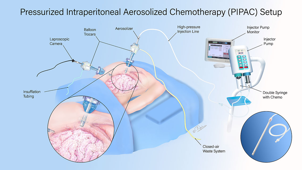 PIPAC procedure. info graphic 2026
